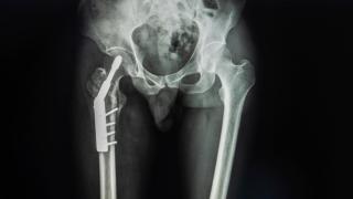 Primeira cirurgia de fêmur é realizada em Senhor do Bonfim após investimentos do Governo do Estado