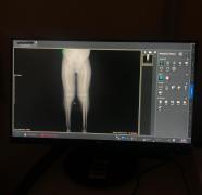 Hospital Ortopédico disponibiliza exame inédito no SUS para diagnóstico de alterações ósseas