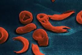 cidadao_usuario_noticias_Falciforme
