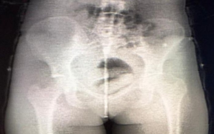 Body scan identifica tentativa de entrada de substância ilícita no Conjunto Penal de Irecê