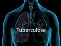 TUBERCULOSE.jpg