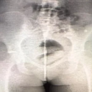 Body scan identifica tentativa de entrada de substância ilícita no Conjunto Penal de Irecê